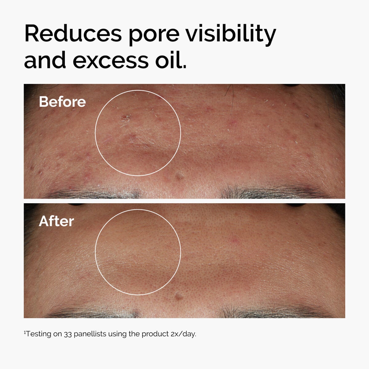 niacinamide-10-zinc-1-i8 ord-niacinamide-zinc-blemish-serum-before-after-pores.jpg