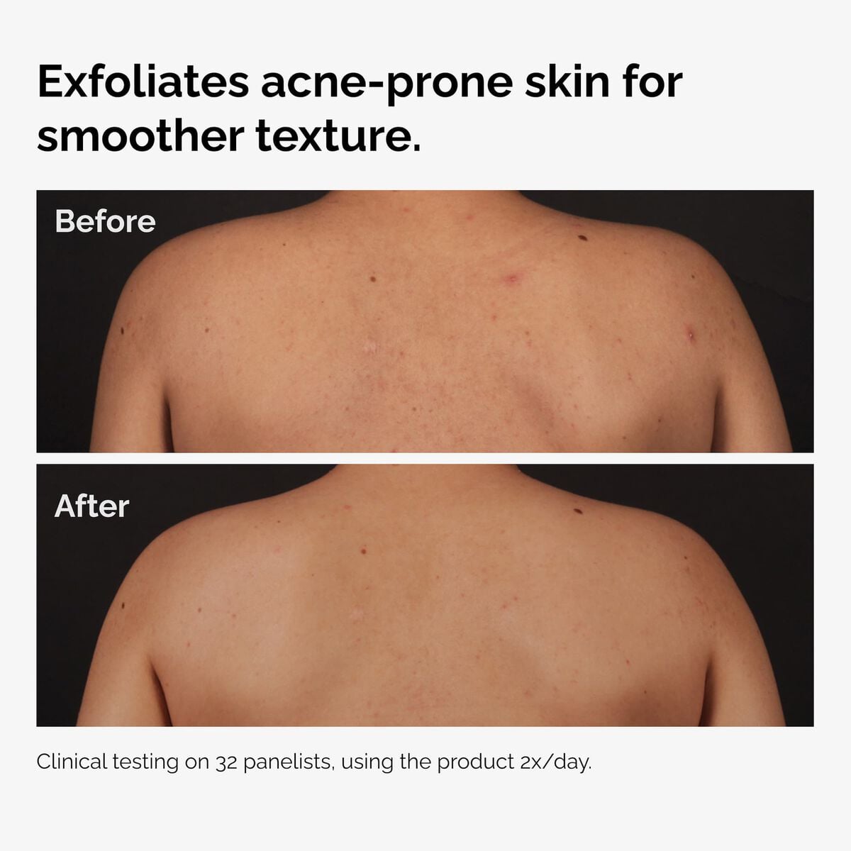salicylic-acid-0-5-body-serum-i7 ord-salicylic-acid-body-serum-before-after-graphic-NA.jpg