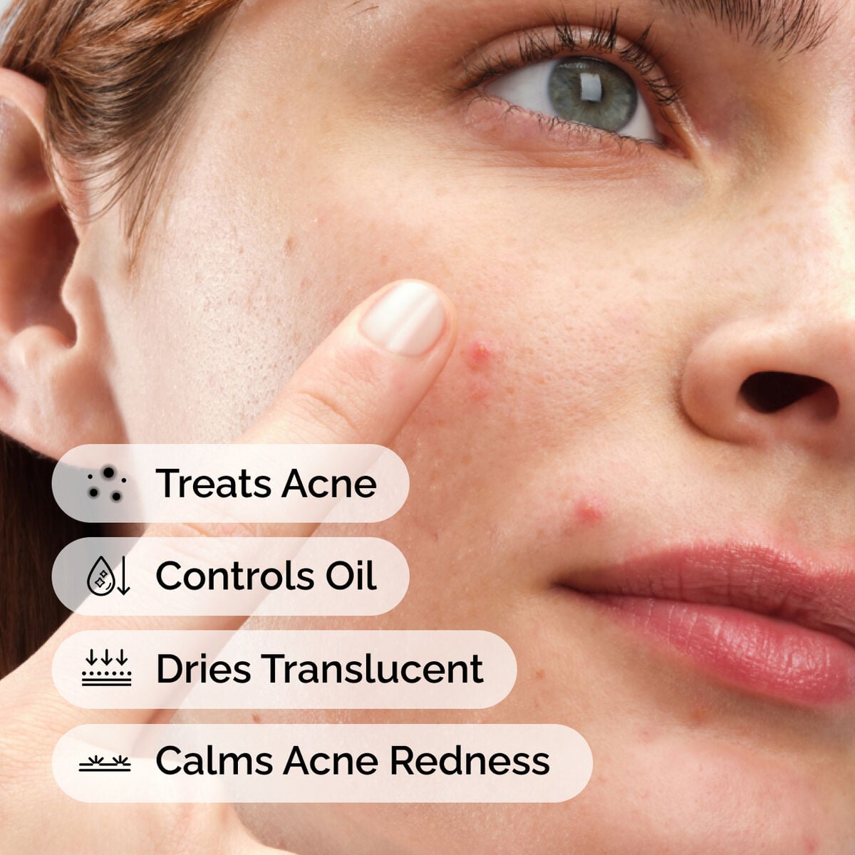sulfur-10-powder-to-cream-concentrate-z5 ord-sulfur-10pct-powder-to-cream-concentrate-model-application-with-benefits-acne.jpg